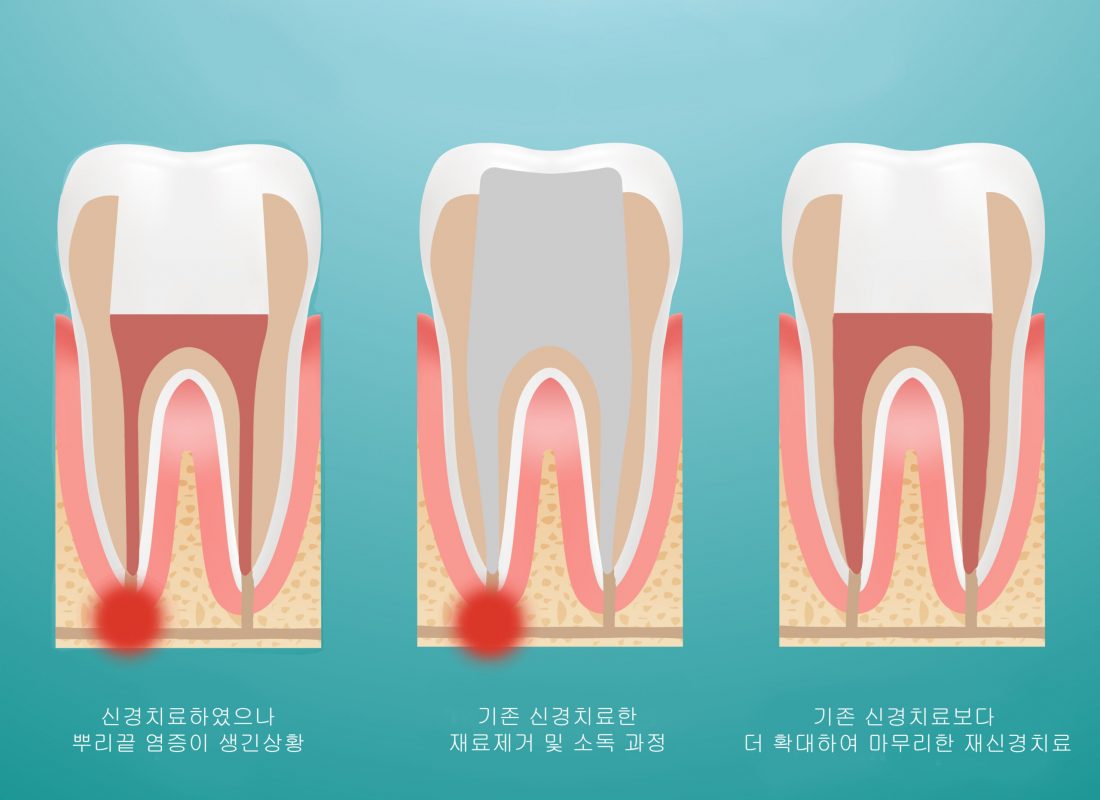 Pulpitis. Root Canal Therapy. Infected Pulp Is Removed From The Tooth And The Space Occupied By It Is Cleaned And Filled With A Gutta Percha Isolated On A Background. Vector Illustration. Pulpitis. Root Canal Therapy. Infected Pulp Is Removed From The Tooth And The Space Occupied By It Is Cleaned And Filled With A Gutta Percha Isolated On A Background. Vector Illustration. Stomatology. Teeth And Tooth Concept Of Dental