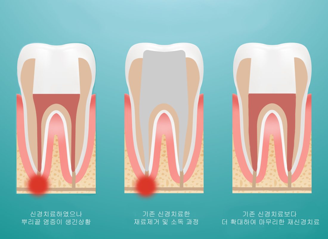 Pulpitis. Root Canal Therapy. Infected Pulp Is Removed From The Tooth And The Space Occupied By It Is Cleaned And Filled With A Gutta Percha Isolated On A Background. Vector Illustration. Stomatology. Teeth And Tooth Concept Of Dental